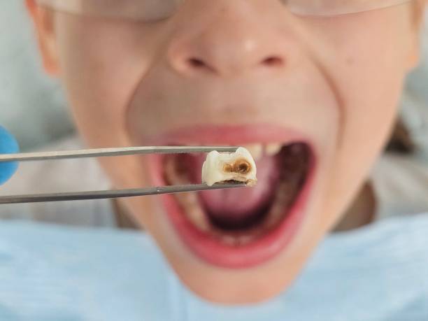 Best Broken or Chipped Tooth Repair in Montverde, FL